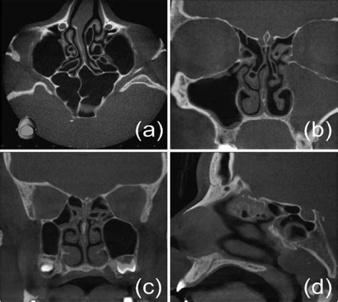 Septal deviation and perforation. aesthetic surgery journal: Deviated Septum Ct Scan Images - ct scan machine