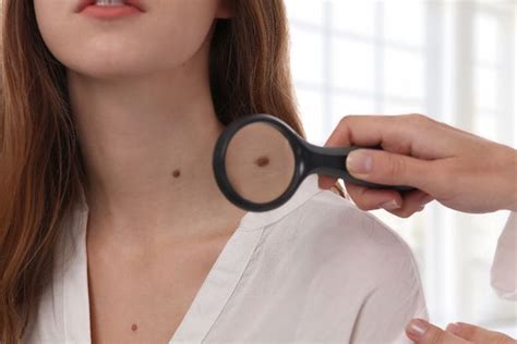 After all, they tend to stick around longer than some people in our lives. How do you know if your mole has become cancerous - RSVP Live