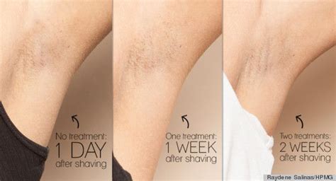 Some hair falls off instantly right after the treatment and some hair takes up to 10 days to fall off. Believe us, laser hair removal IS worth every penny ...