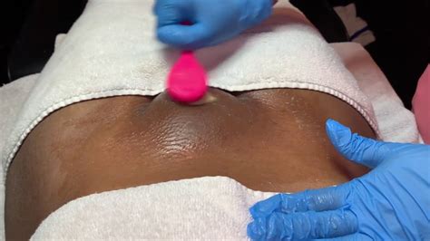 Only if they become infected. DR INGROWN HAIR REMOVAL - EXTRACTIONS & VAJACIAL PART 1 ...