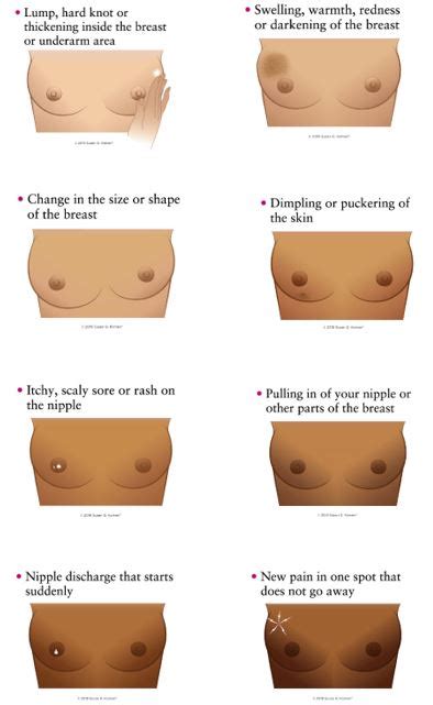 Unlike other types of breast cancer in which surgery is the first modality of treatment, chemotherapy before surgery or radiation therapy is the current standard. Very Early Inflammatory Breast Cancer Rash / Breast Cancer ...