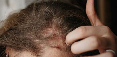 Memakai produk rambut yang berlebihan dan produk yang tidak serasi dengan kulit kepala. Masalah Rambut Gugur Diakibatkan Oleh Kelemumur, Betul Ke?