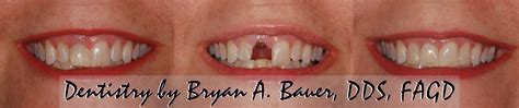 Dental implants can be pricey but dental implant insurance can help. Does dental insurance cover implants - Dental