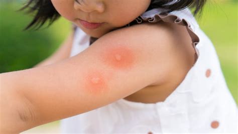 What do they do, this little tribe? How to get rid of mosquito bites and stop the itch - Insider