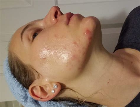 That's just what dermatologists call retinization; My Pre-Wedding Skincare Regimen (Surprise: It's not "All ...