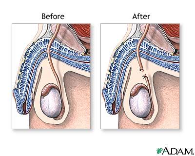 The tubes may be tied, blocked with surgical clips, or closed with an electrical current (this is called cauterizing). Vasectomy - Nursing Crib