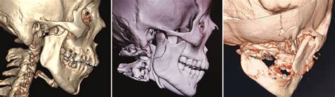 Location of condylar fractures: A: Neck fractures; B ...