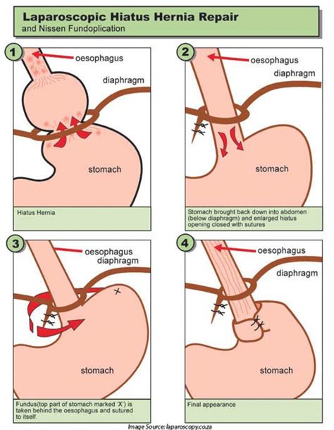 Epigastric hernias are typically small. Hiatal hernia surgery recovery time - THAIPOLICEPLUS.COM