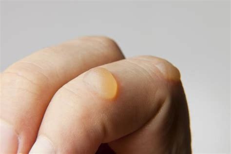 I treated it right away. How To Get Rid Of Blisters Fast? Here Are The Most ...