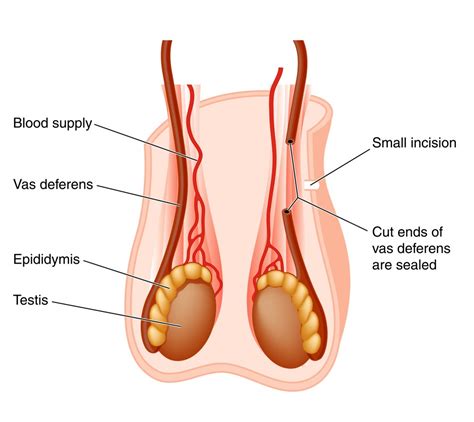 How to do an at home vasectomy. What to Expect From the Vasectomy Procedure and Recovery - Best Penile Implant Surgery NYC
