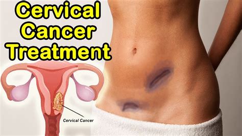 Another out of the most common signs and symptoms of cervical cancer in women is the pain during urination. Top 5 Cervical Cancer Treatment, Stages, Symptoms And More