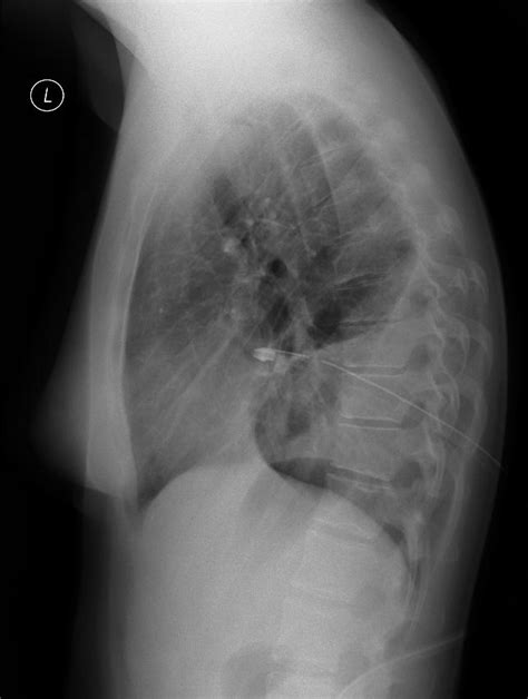 Plicní embolie a její diagnostika. Sono Atlas - nález