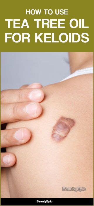 Any wound needs proper healing. How to Use Tea Tree Oil for Keloids? | Tea tree oil, Tree ...