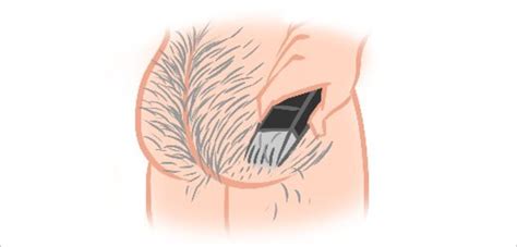 Pilonidal means nest of hair, and doctors sometimes find hair follicles inside the cyst. How to Shave Your Butt (Illustrated)