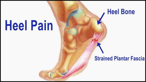 Keadaan ini berlaku kerana kecederaan mikro dan keradangan pada tisu tapak kaki. vitaminsihatalami.blogspot.com: OSTEMATRIX : SAKIT TAPAK ...