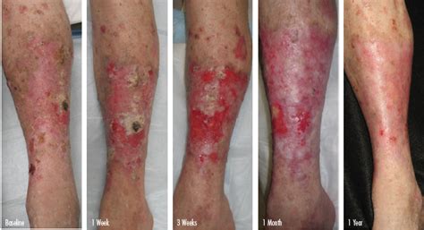 Melanoma accounts for about 1 percent of all skin cancers, but it's responsible for most deaths from skin cancer, according to the american cancer society. Photos