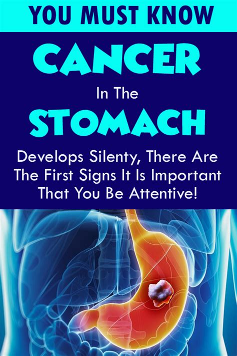 Kidney removed, ten yrs on, still cancer free. Cancer In The Stomach Develops Silently. These Are The ...