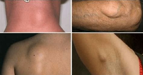 How to treat lipomas naturally. Pin on remedies