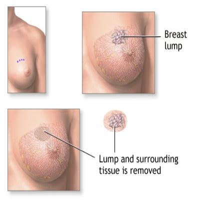 The main symptom of breast cancer is usually a lump or thickened area of tissue in your breast. Reason For Lump In The Breast | Lady Care Health