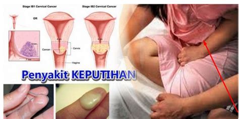 Pada wanita, chlamydia menyerang leher rahim. Mengenal Jenis-Jenis Keputihan