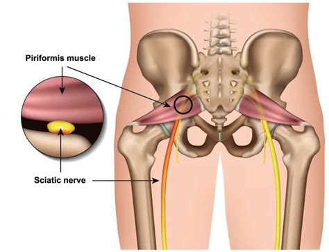 What is the piriformis syndrome and how can you test and treat it yourself. Piriformis Syndrome - Sports Medicine Information