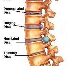 Slip discs cause slip disc problems when the outer ring weakens or becomes damaged and the inner part finds a way out. Bekam, Akupuntur, Pembetulan Tulang Belakang di Seri ...