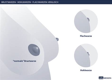 Wir schreiben heute montag, den 19.07.2021. Schlupfwarzen: Was hilft gegen Hohlwarzen? | info Medizin