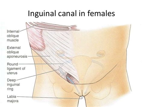 This leaflet gives a brief description of some of these causes and signposts to where more information on the individual conditions may be obtained. Inguinal Hernia & Endometriosis - Bloomin' Uterus