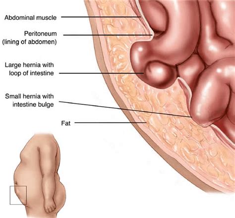 We did not find results for: Hernia Symptoms - California Hernia Specialists