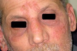 Recurrent infections tend to be milder than primary infections and generally occur in the same location as the primary infection. Disseminated primary HSV-2 infection of the face