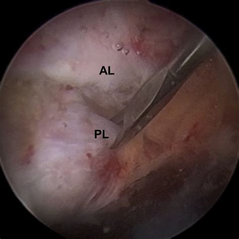 In 1986 on outlet view radiographs, and later modified by kitay et al. Bigliani ' s classification of acromion undersurface with ...