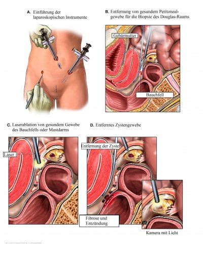 Inhaltsverzeichnis verbergen 2 wann muss ich steuern nachzahlen? Eierstockzyste, Schmerzen, Eierstockkrebs, Symptome, Operation