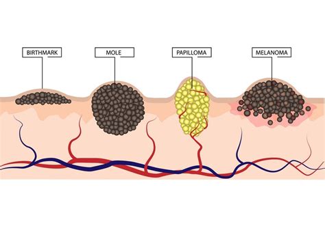 There are three main types of skin cancers: Early signs of Skin Cancer | Skin We Are In