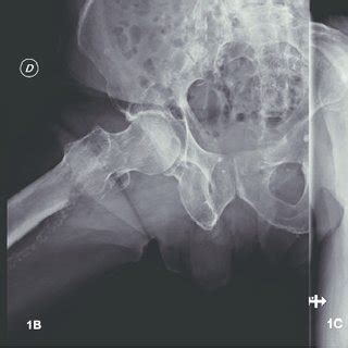 An avulsion fracture occurs when a tendon or ligament attached to a bone pulls against it and fractures off a piece of the bone. (PDF) Isolated Fracture of the Lesser Trochanter as a ...
