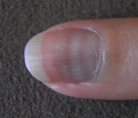 Clubbing leukonychia asterixis palmar organic causes such as dementia pseudodementia pain importuniing (whingeing, complaining). Leukonychia definition, causes, treatment & prognosis