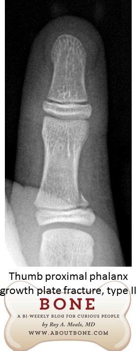 thumb proximal phalanx fracture through the growth plate ...