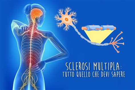 Sclerosi multipla recidivante con remissione (smrr): Sclerosi multipla, la malattia invisibile che ti cambia la ...