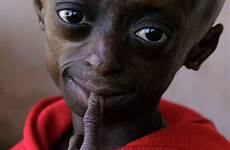progeria bolezni