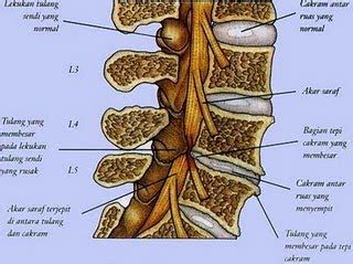 Gangguan persarafan di tulang belakang terutama disekitar lumbar yang disebabkan kedudukan saraf yang terjepit kerana kecederaan di tulang belakang yang bearakibat sakit di pinggang, di punggung atau sakit dan kebas kaki bahkan susah untuk berjalan. APA ITU SLIP DISC TULANG BELAKANG? | ...Jurnal Kehidupan...