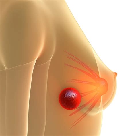 It can also return and spread to other parts of the body (called metastasis or distant recurrence). Characteristics of Breast Cancer Lumps | Livestrong.com