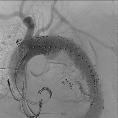 Gouveia is a brazilian municipality located in the center of the state of minas gerais. After deployment of the thoracic endovascular aortic repair (TEVAR)... | Download Scientific Diagram