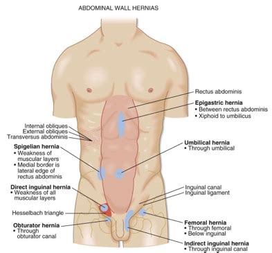 Sometimes there is a history of minor injury to the part a few days before the onset of acute symptoms. Inguinal Hernia, Umbilical Hernia surgeries Doing In ...
