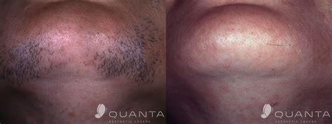 What you need to know about laser hair removal on chin hair. Laser Hair Removal Lafayette, CO | aRejuvenation Skin Care