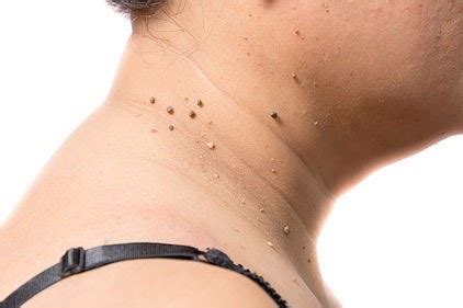 Skin tags are usually found on the neck, armpits, around the groin, or under the breasts. Skin Tags: Removal, Causes & Treatments | Middlesex County ...