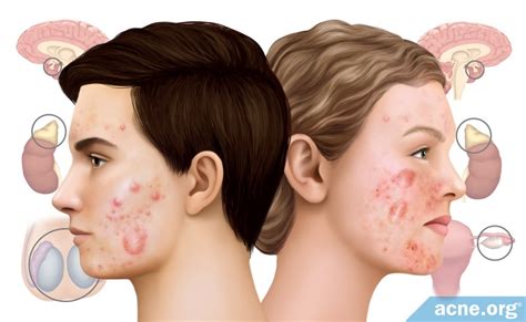 During your appointment, a dermatologist will also note what types of acne you have and where the breakouts appear on your skin. Do Hormones Cause Cystic Acne? - Acne.org