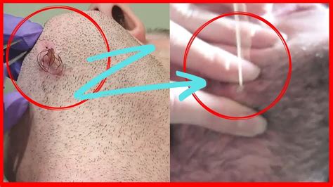 To treat ingrown hairs, stop shaving, tweezing or waxing until the condition improves — usually one to six months. Oddly Satisfying Ingrown Hair Removal | Part 2 | (2019 ...