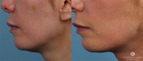 How long does kybella last? How Long Do Kybella® Results Last? | Chevy Chase Kybella ...