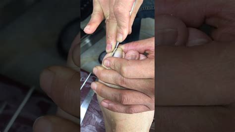 It also helps in treating wounds and bringing out the ingrown hair. High tech pull out Ingrown Nail 27 - YouTube