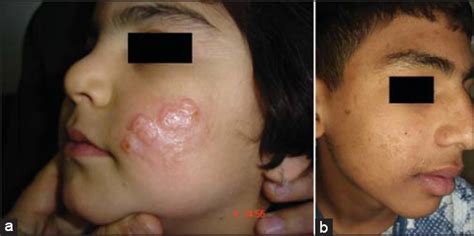 Bumps on buttocks | med health daily. Original_Article | Our Dermatology Online journal