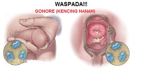 Makanan apa saya wajib ambil? Obat Lubang Anus atau Dubur Keluar Nanah Setelah Anal Sex ...